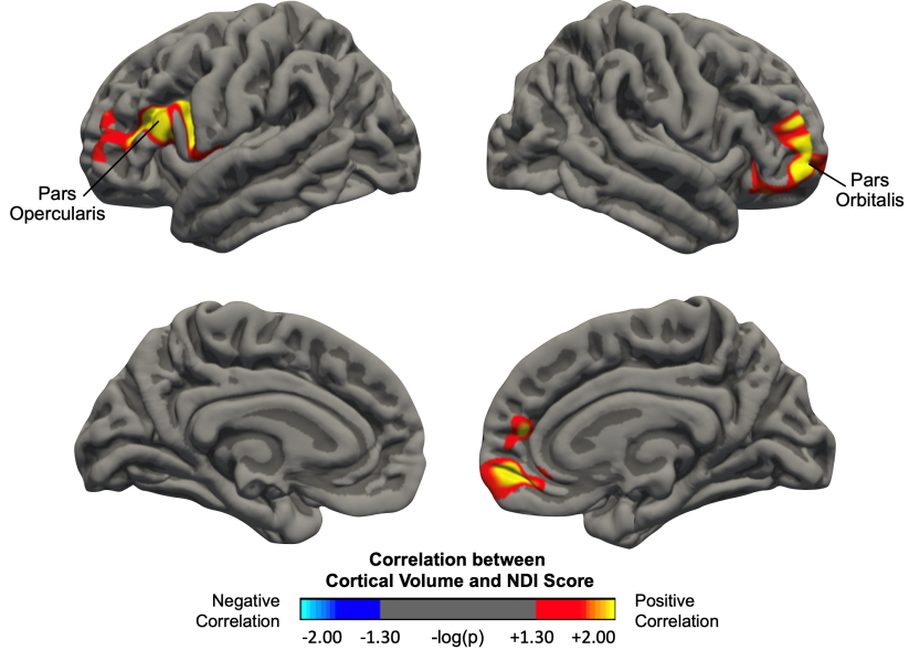 16 Sex Related Cortical Alterations In Patients With Degenerative